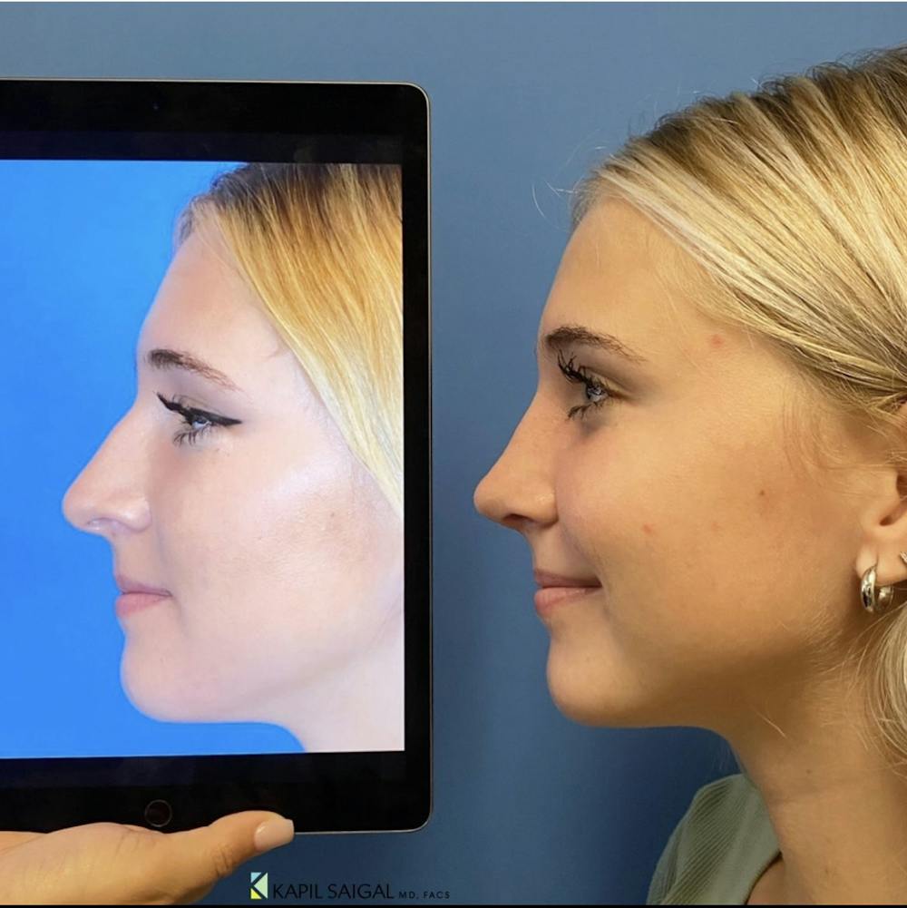 Rhinoplasty Before & After Gallery - Patient 249525 - Image 1