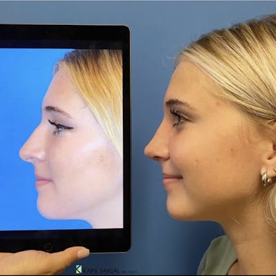 Rhinoplasty Before & After Gallery - Patient 249525 - Image 1