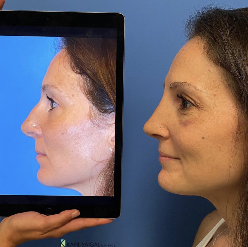 Rhinoplasty Before & After Gallery - Patient 285057 - Image 1