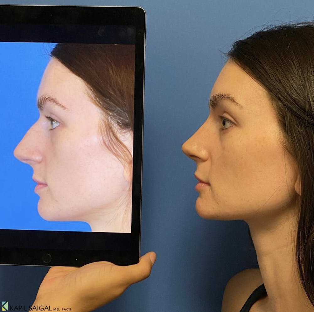 Rhinoplasty Before & After Gallery - Patient 720619 - Image 1