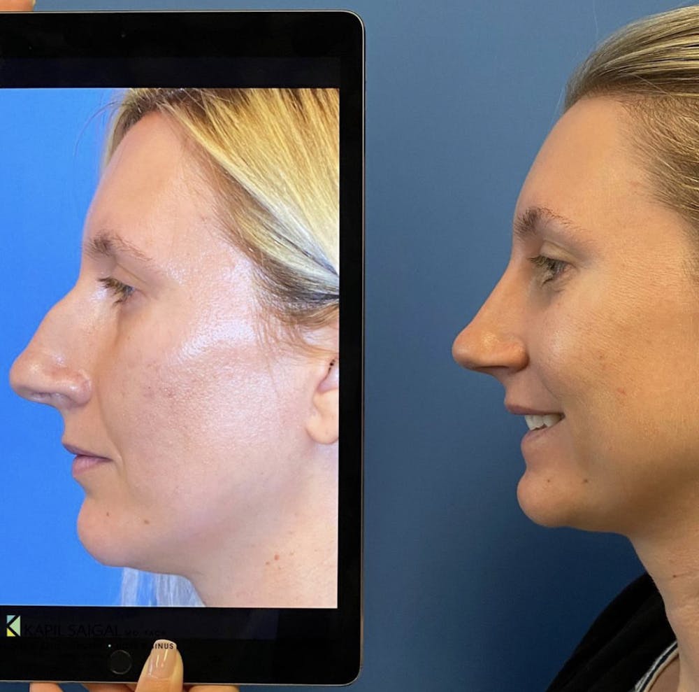 Rhinoplasty Before & After Gallery - Patient 539108 - Image 1