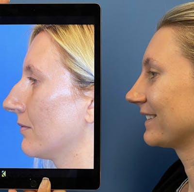 Rhinoplasty Before & After Gallery - Patient 539108 - Image 1