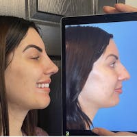 Rhinoplasty Before & After Gallery - Patient 289374 - Image 1