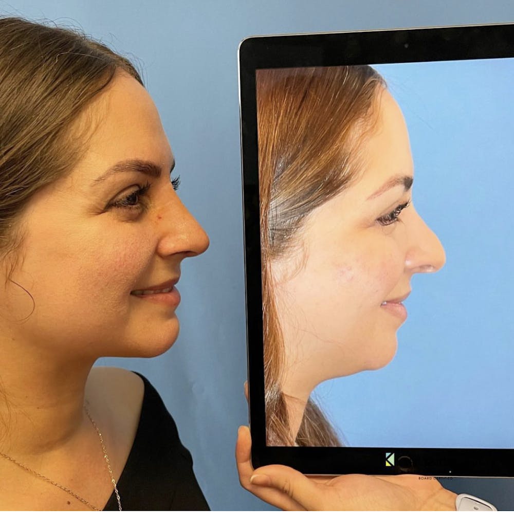 Rhinoplasty Before & After Gallery - Patient 344699 - Image 1