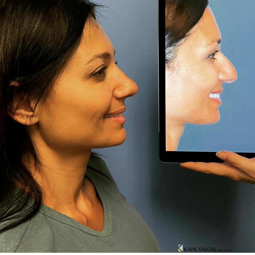 Rhinoplasty Before & After Gallery - Patient 143116 - Image 1