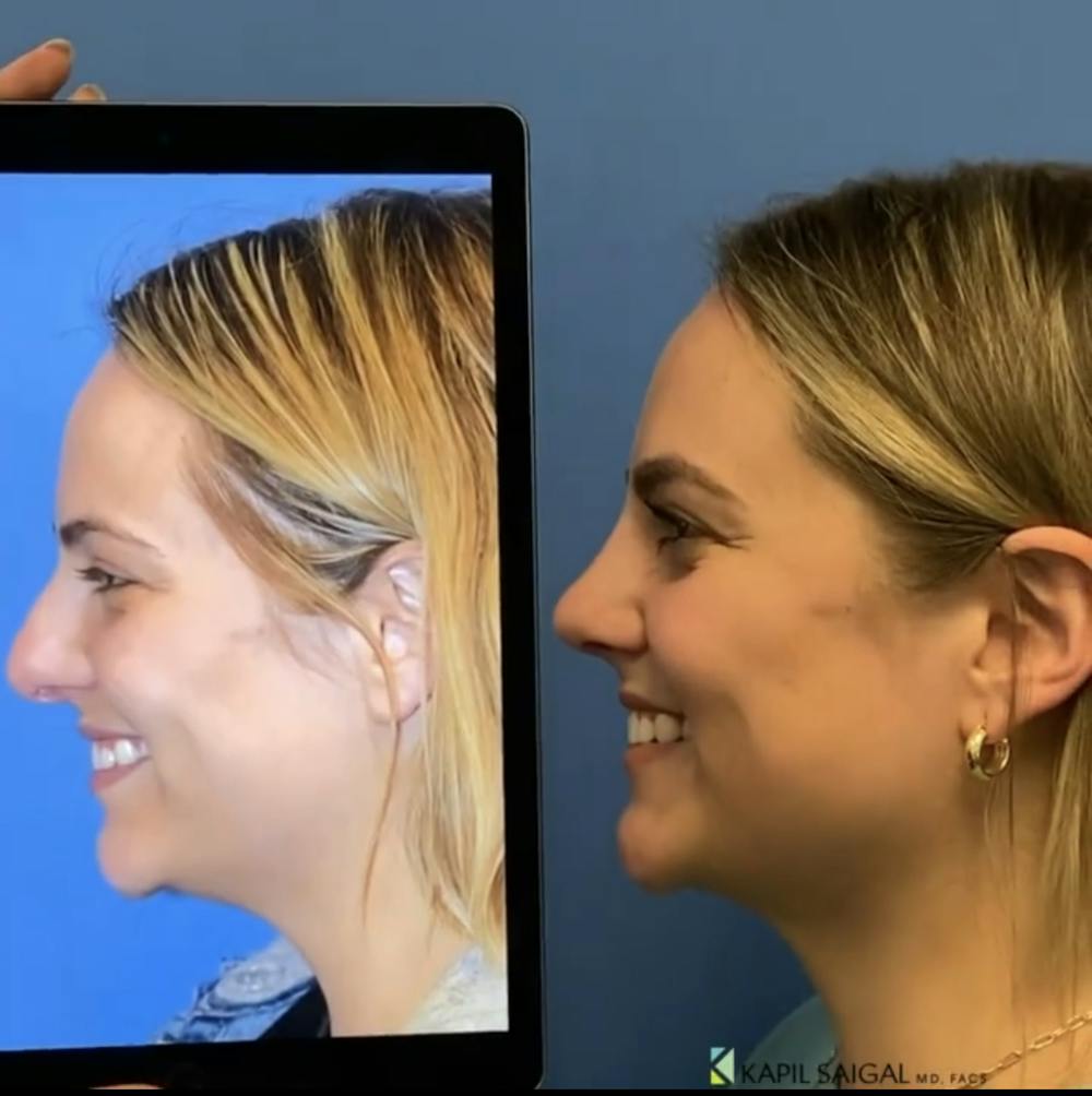 Rhinoplasty Before & After Gallery - Patient 947992 - Image 1