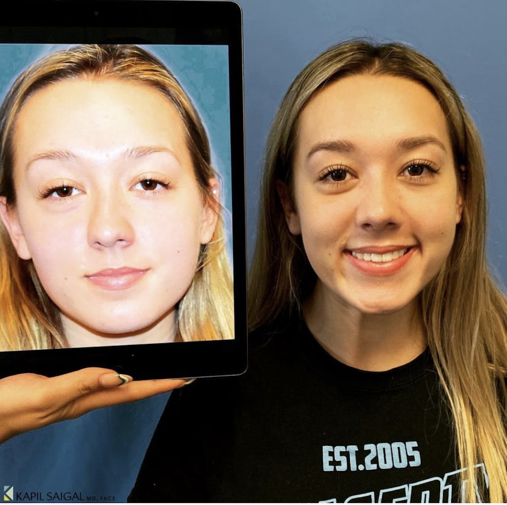 Rhinoplasty Before & After Gallery - Patient 106220 - Image 1
