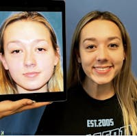 Rhinoplasty Before & After Gallery - Patient 106220 - Image 1