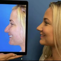 Rhinoplasty Before & After Gallery - Patient 126965 - Image 1