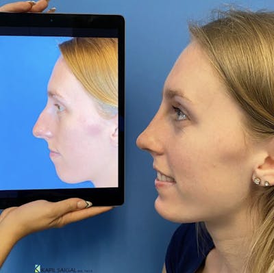 Rhinoplasty Before & After Gallery - Patient 359380 - Image 1