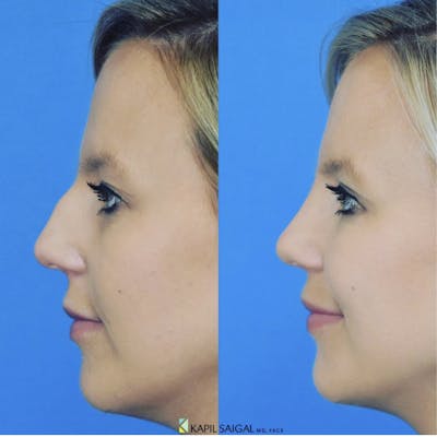 Rhinoplasty Before & After Gallery - Patient 403548 - Image 1