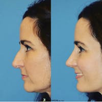 Rhinoplasty Before & After Gallery - Patient 150690 - Image 1