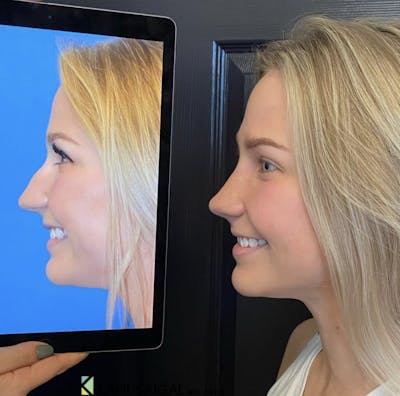 Rhinoplasty Before & After Gallery - Patient 136747 - Image 1