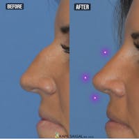 Rhinoplasty Before & After Gallery - Patient 429127 - Image 1