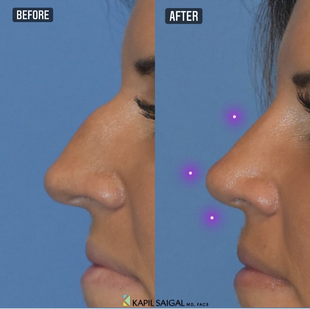 Rhinoplasty Before & After Gallery - Patient 429127 - Image 1