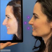 Rhinoplasty Before & After Gallery - Patient 408944 - Image 1