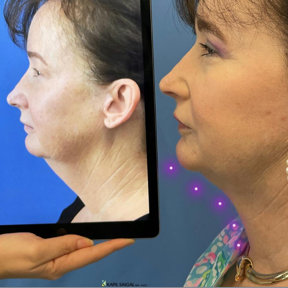 Facelift & Neck Lift Before & After Gallery - Patient 399400 - Image 1