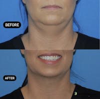 Facelift & Neck Lift Before & After Gallery - Patient 377546 - Image 1