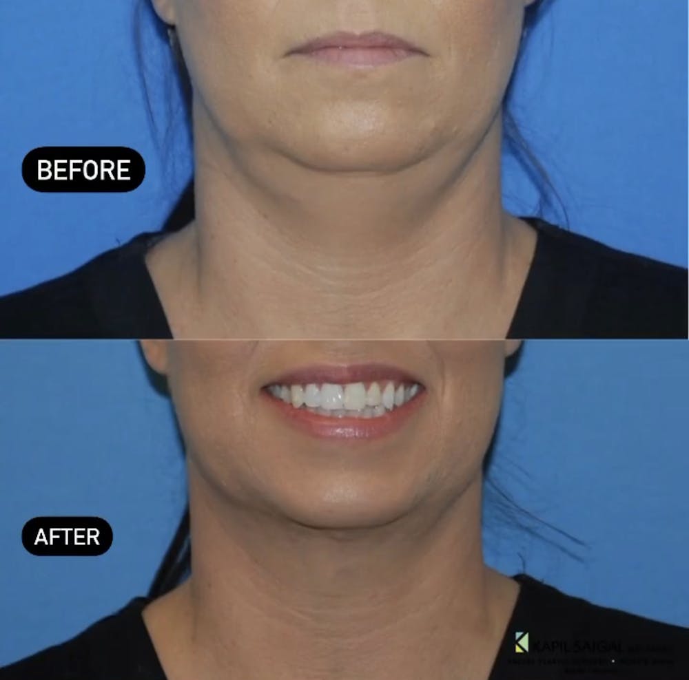Facelift & Neck Lift Before & After Gallery - Patient 377546 - Image 1