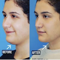 Neck Liposuction Before & After Gallery - Patient 220209 - Image 1