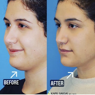 Neck Liposuction Before & After Gallery - Patient 220209 - Image 1