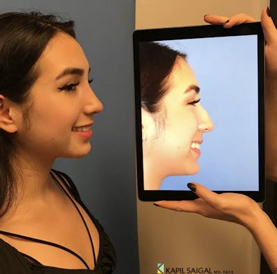 Rhinoplasty Before & After Gallery - Patient 402767 - Image 1