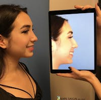 Rhinoplasty Before & After Gallery - Patient 402767 - Image 1