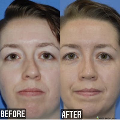 Rhinoplasty Before & After Gallery - Patient 287813 - Image 1
