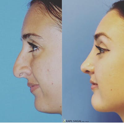 Rhinoplasty Before & After Gallery - Patient 119056 - Image 1