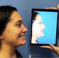 Rhinoplasty Before & After Gallery - Patient 245894 - Image 1