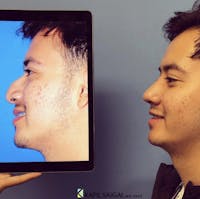 Rhinoplasty Before & After Gallery - Patient 324655 - Image 1