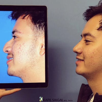 Rhinoplasty Before & After Gallery - Patient 324655 - Image 1