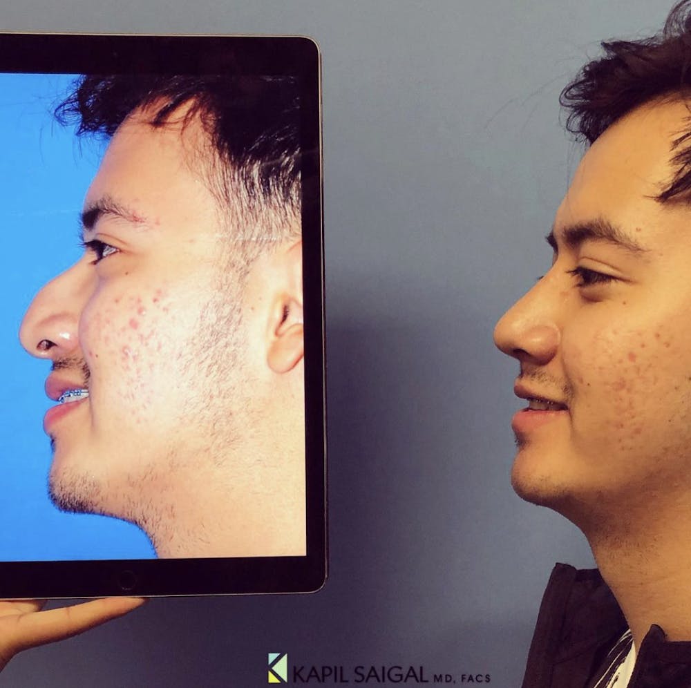 Rhinoplasty Before & After Gallery - Patient 324655 - Image 1