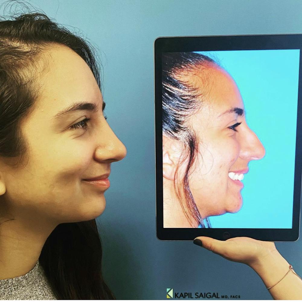 Rhinoplasty Before & After Gallery - Patient 994945 - Image 1
