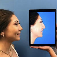 Rhinoplasty Before & After Gallery - Patient 227000 - Image 1