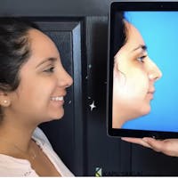 Rhinoplasty Before & After Gallery - Patient 298854 - Image 1
