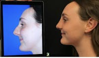 Rhinoplasty Before & After Gallery - Patient 113938 - Image 1