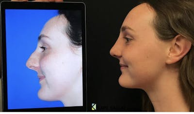 Rhinoplasty Before & After Gallery - Patient 113938 - Image 1
