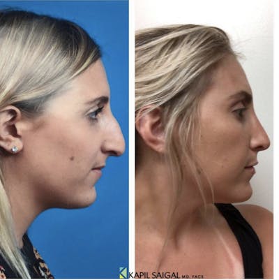 Rhinoplasty Before & After Gallery - Patient 579089 - Image 1