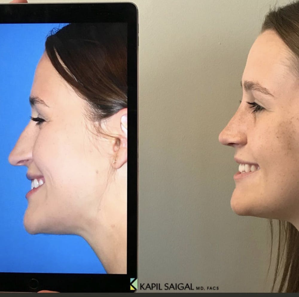 Rhinoplasty Before & After Gallery - Patient 355843 - Image 1