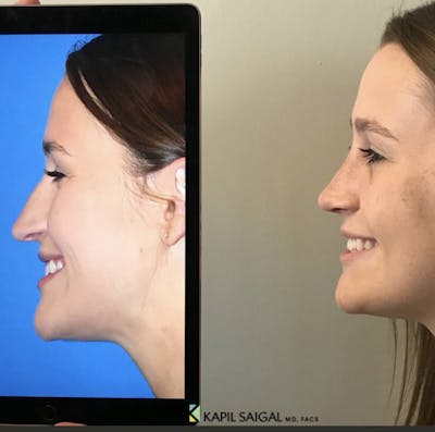 Rhinoplasty Before & After Gallery - Patient 355843 - Image 1