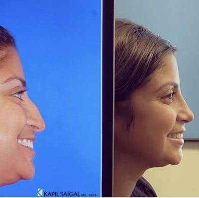 Rhinoplasty Before & After Gallery - Patient 201317 - Image 1