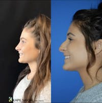 Rhinoplasty Before & After Gallery - Patient 176419 - Image 1