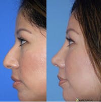 Rhinoplasty Before & After Gallery - Patient 144964 - Image 1