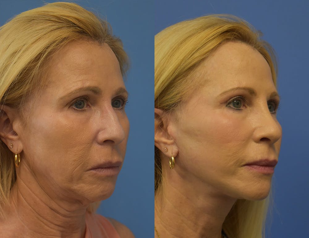 Facelift & Neck Lift Before & After Gallery - Patient 250314 - Image 1