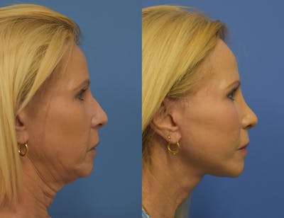 Rhinoplasty Before & After Gallery - Patient 205794 - Image 2