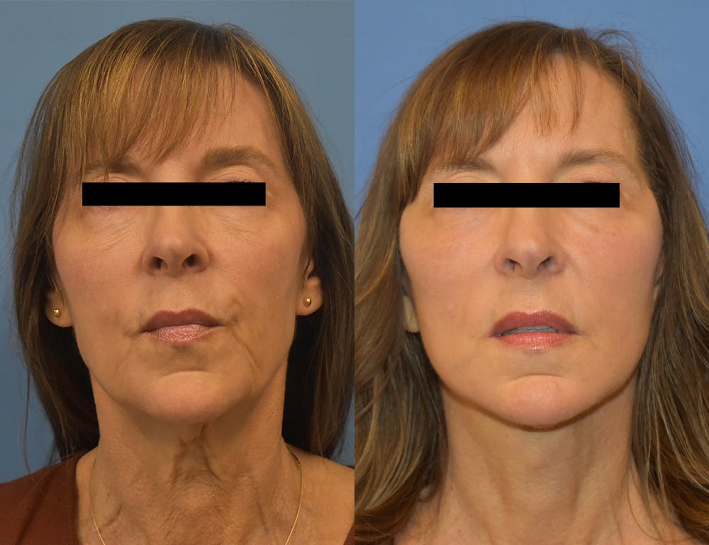 Facelift & Neck Lift Before & After Gallery - Patient 371713 - Image 2