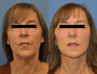 CO2 Laser Resurfacing Before & After Gallery - Patient 178113 - Image 1