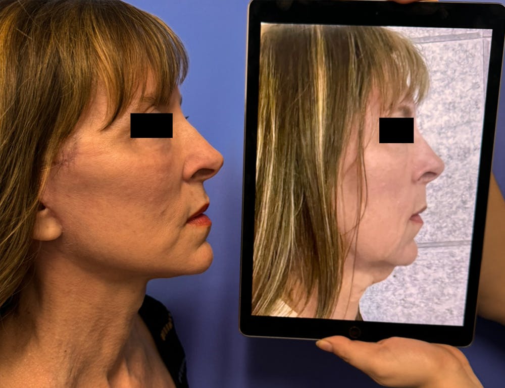 Facelift & Neck Lift Before & After Gallery - Patient 371713 - Image 1