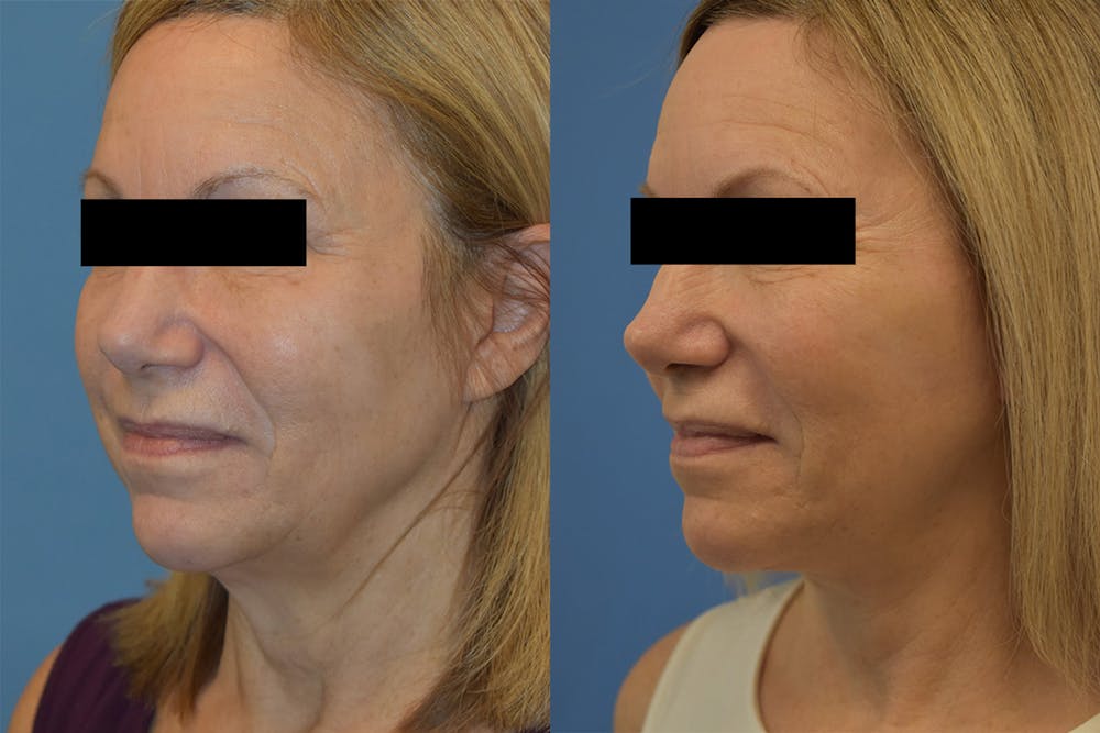 Facelift & Neck Lift Before & After Gallery - Patient 214587 - Image 1